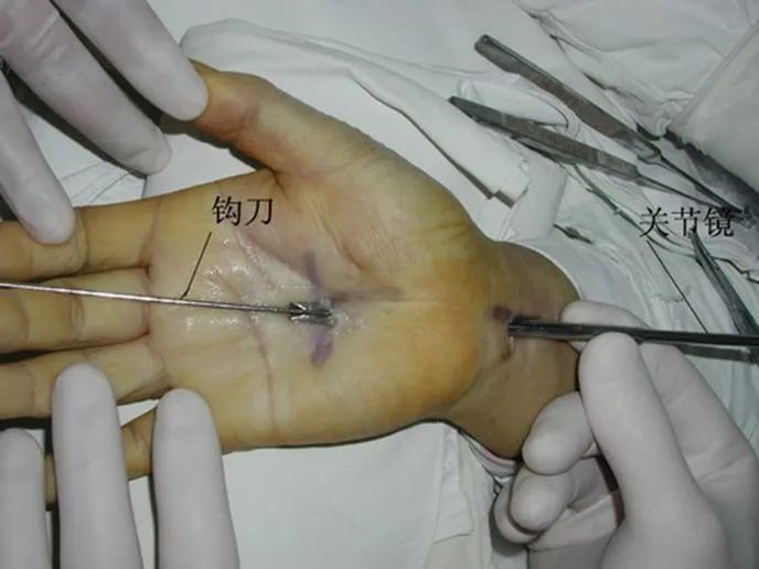 微型钩刀治疗腕管综合征具有皮肤切口小,组织创伤轻,手术时间短,临床